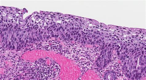 High Grade Squamous Intraepithelial Lesion Of The Cervix Atlas Of Pathology