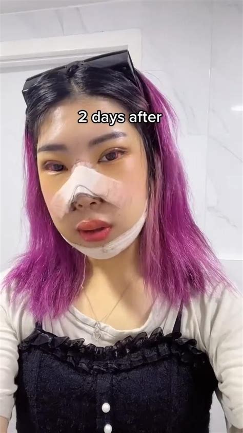 Korean Plastic Surgery Post Op Transformation And Recovery Plastic Surgery Beautiful Women