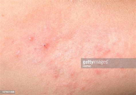 Red Bumps On Skin Photos And Premium High Res Pictures Getty Images