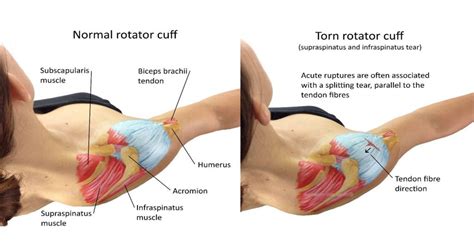 Tendinitis is an inflammation or swelling of a tendon. Different Types Of Rotator Cuff Injuries
