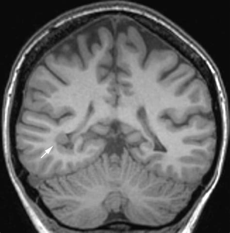 Imaging In Epilepsy Journal Of Neurology Neurosurgery And Psychiatry