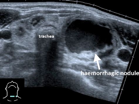 Figure 15 From Practical Approach To Thyroid Nodulesultrasound