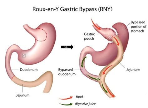 Roux En Y Gastric Bypass Dramit Garg