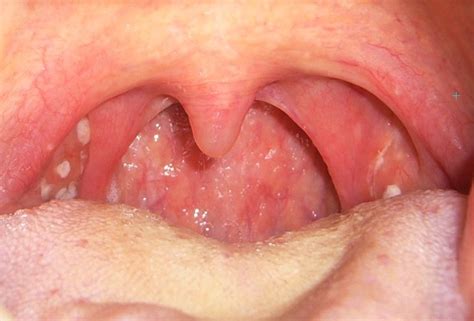 White Spots On Tonsils Causes Symptoms Treatment Risks The Best Porn Website