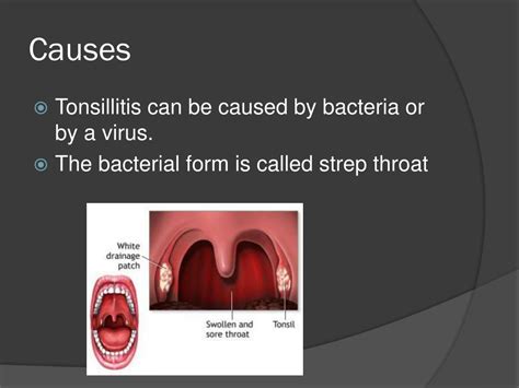 Ppt Tonsillitis Powerpoint Presentation Free Download Id2152221