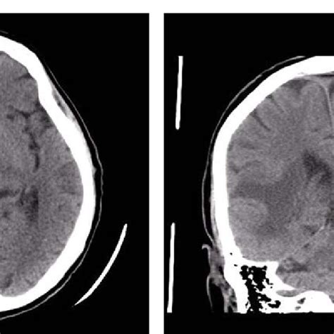 Head Ct Right Subcortical Temporal Hyperdense Expansive Lesion With
