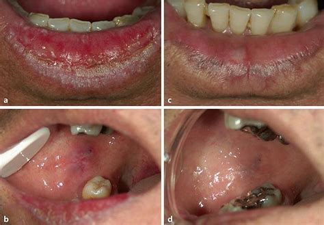 A Erosive Oral Lichen Planus Olp Lesions Affecting The Lower Lip Of