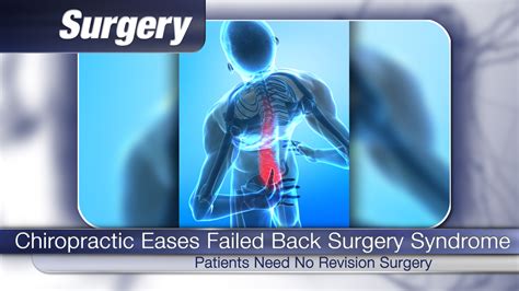 Video Chiropractic Eases Failed Back Surgery Syndrome Chironexus News