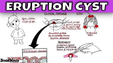 🌈 Eruption Cyst Eruption Cyst Treatment At Richardsons Craniofacial