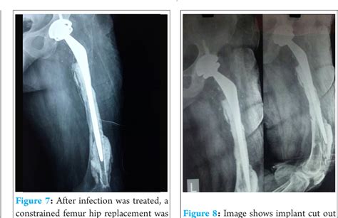 Figure 7 From A Case Report Of Dual Incision Technique For Total Femur