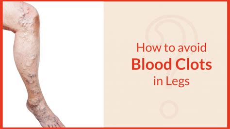 How To Prevent Blood Clots In Legs Heartpolicy6