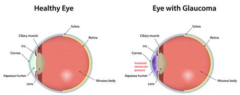 Glaucoma Indianapolis Glaucoma Greenwood Lanter Eyecare