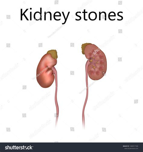 Kidney Stones Urolithiasis Renal Lithiasis Nephrolithiasis Stock Vector