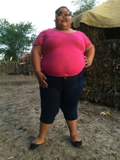 Chavita Mexicana Es El Caso De Mayor Obesidad Extrema En El Mundo