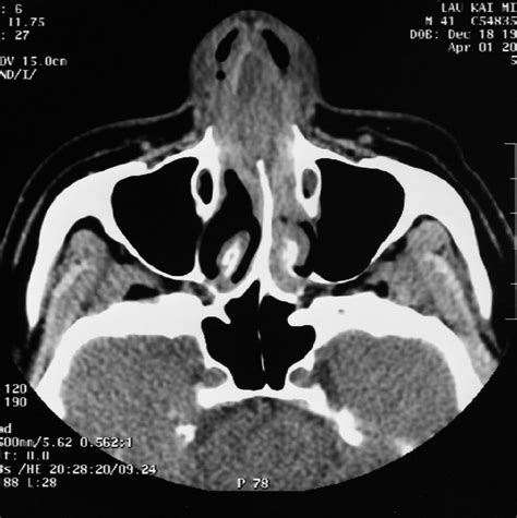 Spontaneous Nasal Septal Abscess Presenting As Complete Nasal Obstruction