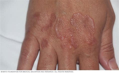 Granuloma Annulare Disease Reference Guide