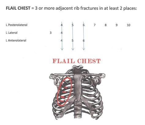 Your rib cage functions to protect some of your most vital organs and so can often be the first body part affected after a traumatic injury. Flail Chest - life-threatening medical condition that ...