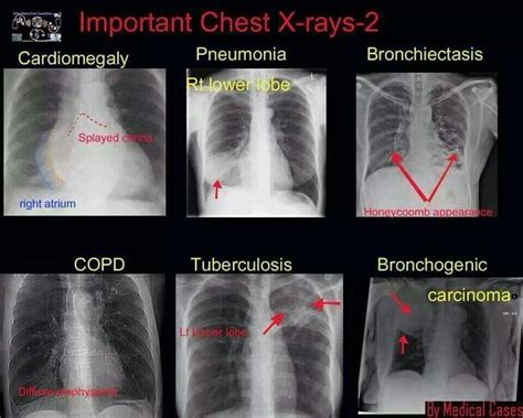 Image Of Chest X Ray With Copd Mageusi