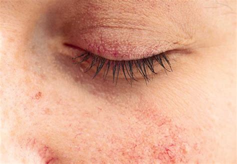 ¿qué Es La Dermatitis En Los Párpados Área Oftalmológica Avanzada
