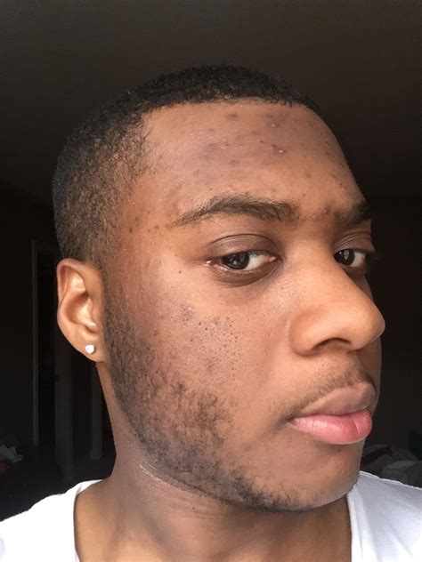 Photos Uneven Skin Tone How Do I Fix African American Skin Scar