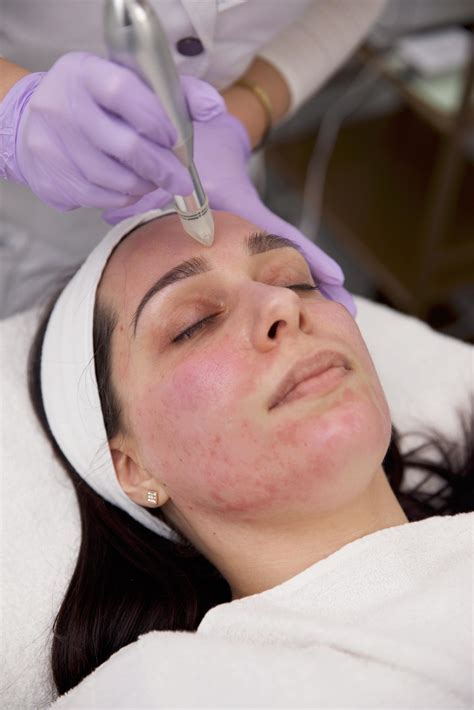 Collagen Induction Therapy The One Clinic