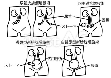 Free Vectors Urinary Diversion Surgery Character And Line Drawing