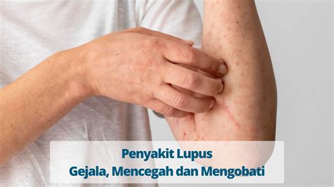 Penyakit Lupus Gejala Mencegah Dan Mengobati