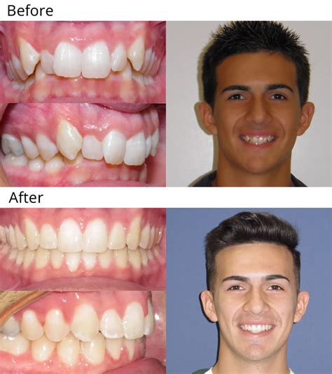 Braces Jaw Overbite Before And After Before And After