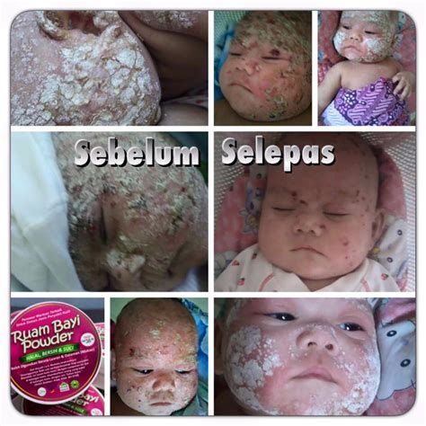 Namun sementara itu, ada beberapa perkara yang anda boleh lakukan untuk melegakan jangan gunakan salap dan losyen lain kerana ianya akan membuat ruam menjadi lebih teruk dengan cara memerangkap kelembapan dalam kulit. Ruam Baby Powder Penawar Penyakit Kulit - Mieza S