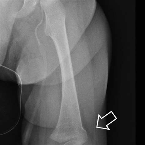 4 Childhood Accidental Spiral Tibia Fracture In A 16 Month Old Boy