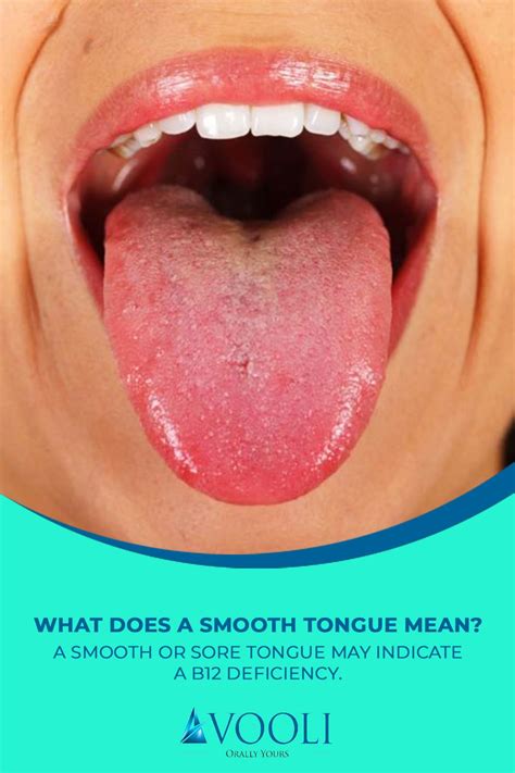 What Does A Smooth Tongue Mean A Smooth Or Sore Tongue May Indicate A