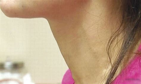 Severe Pulsating Neck Veins Led Doctors To Diagnose Her With Potentially Deadly Heart Condition