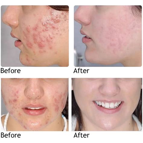 best acne treatment for teens all you need infos