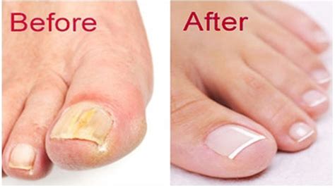 Vicks has addressed another vaporub rumor that postulates using the product to combat toenail and fingernail fungus (an alternate use of the product that has been ballyhooed by a number of folks for years, including author dr. Does Vicks Vaporub really cure toenail fungus? - Quora