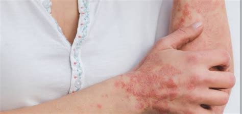 Alergi Kulit Pada Anak Jenis Gejala Dan Langkah Pencegahan