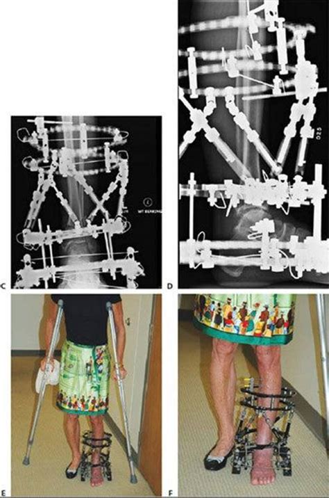 Supramalleolar Osteotomy With External Fixation Perspective 1 Foot