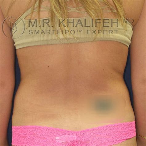 Patient Abdominal Liposuction Flank Lower Back Liposuction