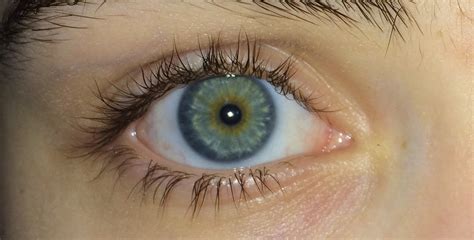 Fileblue Green Eyes With Central Heterochromia Wikimedia Commons