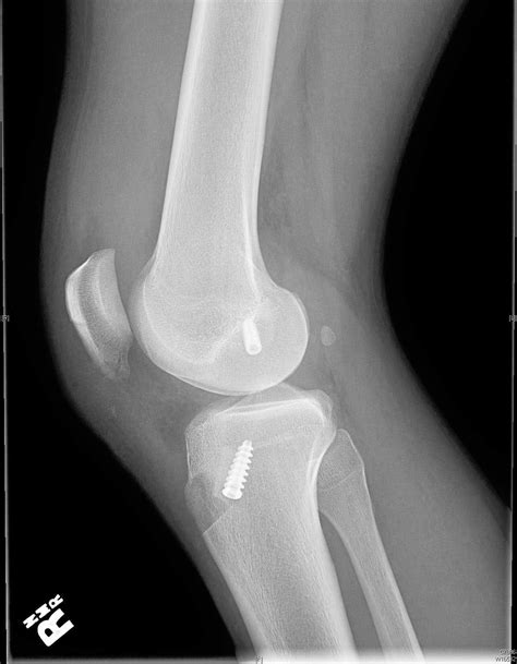Arthroscopic ACL Reconstruction with Bone Patellar Bone Graft using