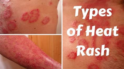 Types Of Heat Rash Heat Rash Types Of Skin Rashes Treating Skin Rash