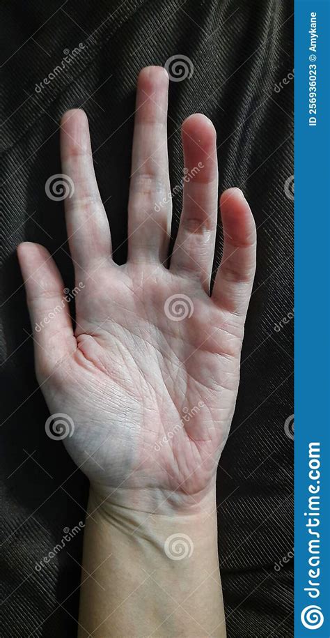 Fingers And Left Palm Human Hand Dark Blue Veins Stock Image Image Of