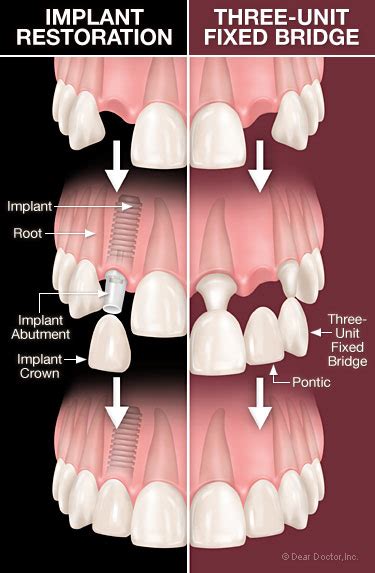 Dental Implants Vs Bridgework Dear Doctor Dentistry And Oral Health