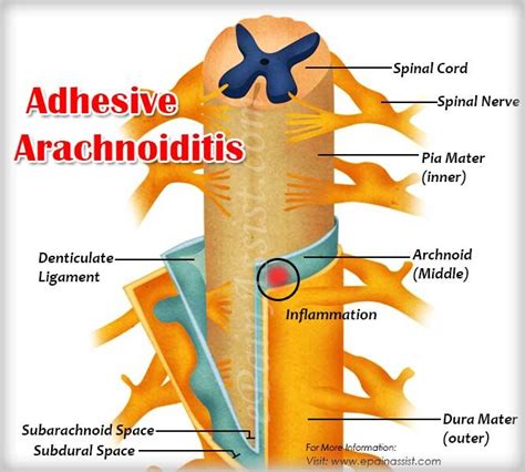 13 Best Adhesive Arachnoiditis Images On Pinterest Adhesivo Dolor