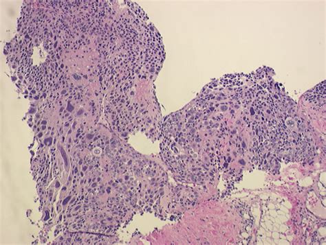 Biopsy Of Supraclavicular Lymph Node Showing Undifferentiated Giant