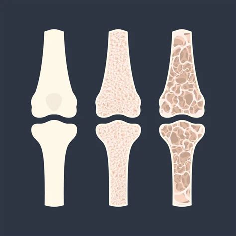 Osteoporotic Bone Imágenes De Stock De Arte Vectorial Depositphotos