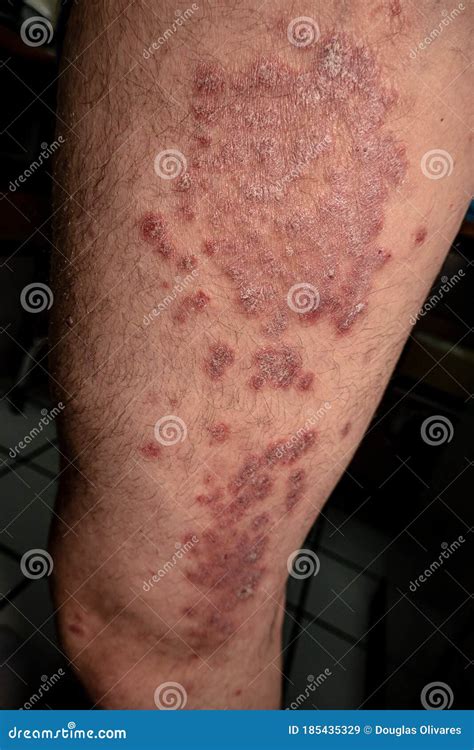 Psoriasis Is A Chronic Inflammatory Autoinmune Skin Disease Stock