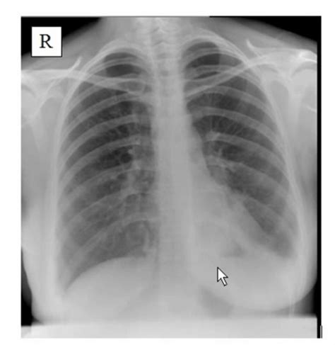 Pneumonia Chest X Ray Pleural Effusion On Vimeo