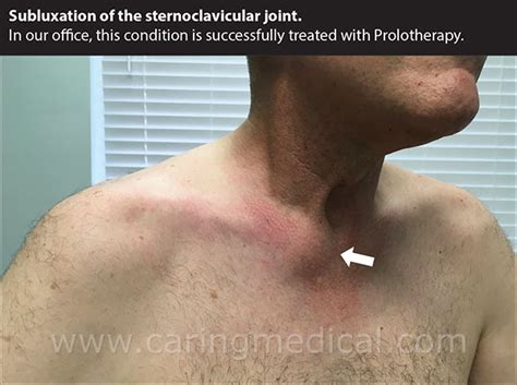 Sternoclavicular Post Traumatic Joint Injury And Instability Treatment
