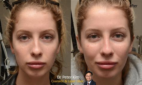 Cosmetic Injection Sydney Dr Peter Kim Surgery Skin Cancer