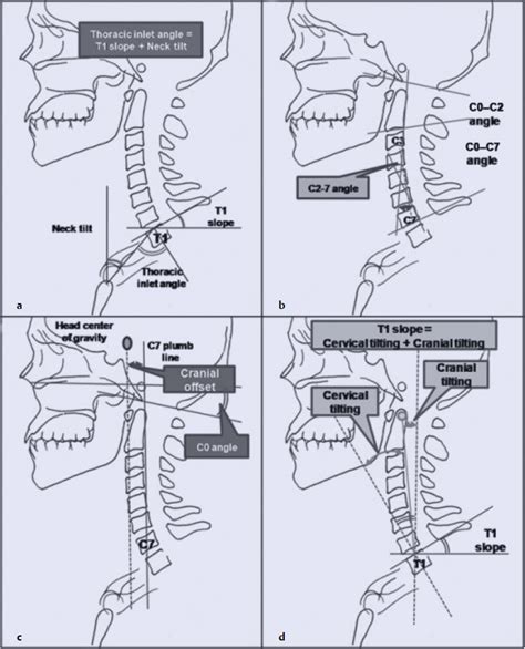 Cervical Sagittal Balance What Is Normal And What Is The Effect On
